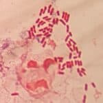 Photograph of a white blood cell and gram negative rods from a positive blood culture